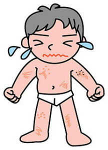 アレルギーによる湿疹
